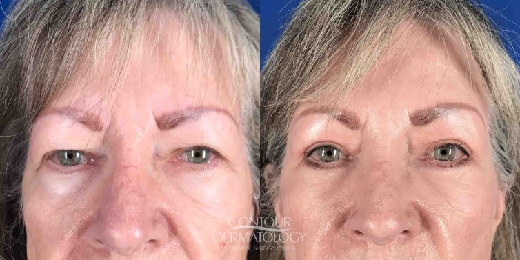 Upper eyelid surgery (upper blepharoplasty) - woman