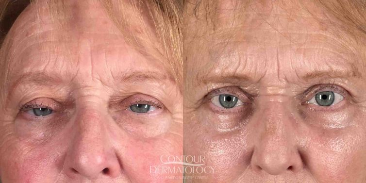 Lower eyelid surgery (lower blepharoplasty) and CO2 laser (around eyes) - woman