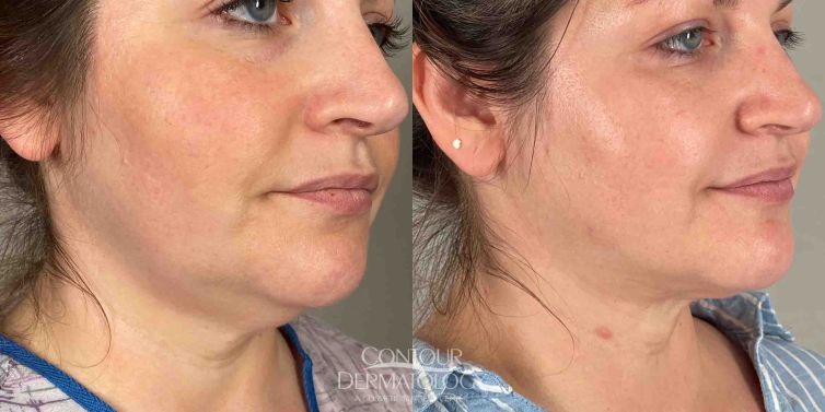 Chin liposculpture - woman