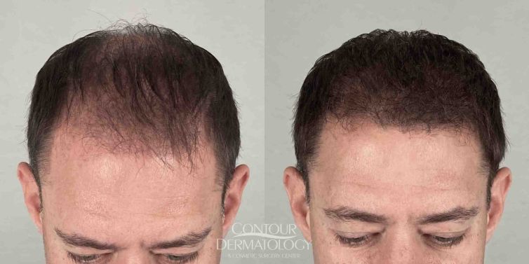 NeoGraft hair transplant (FUE, follicular unit extraction)- man