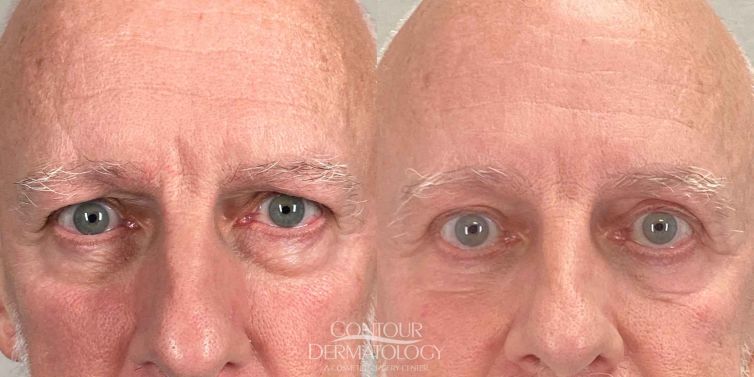 Lower eyelid surgery (lower blepharoplasty) - man