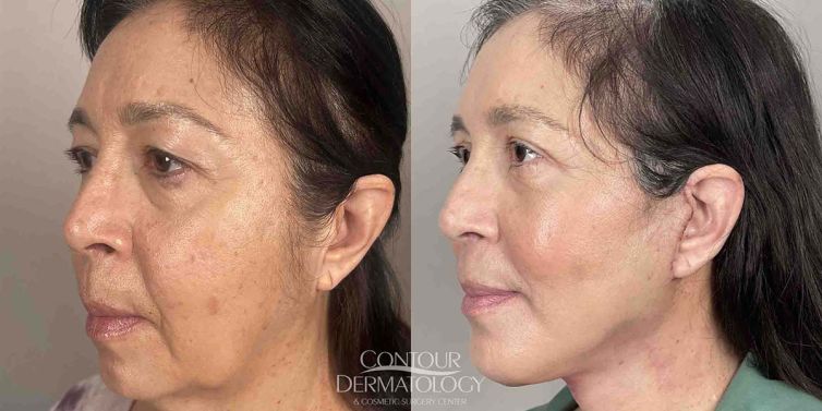 Plastic Surgery Facelift, lower eyelid surgery and chin implant before and after photo.