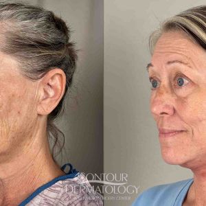 Mini Facelift, 3 months after surgery.