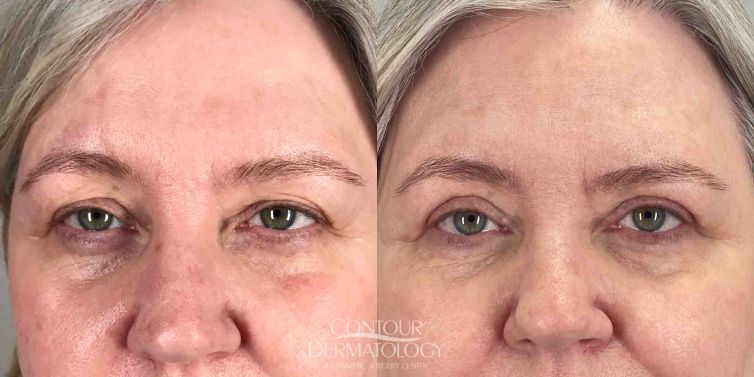 Upper Eyelid Surgery (Upper Blepharoplasty)