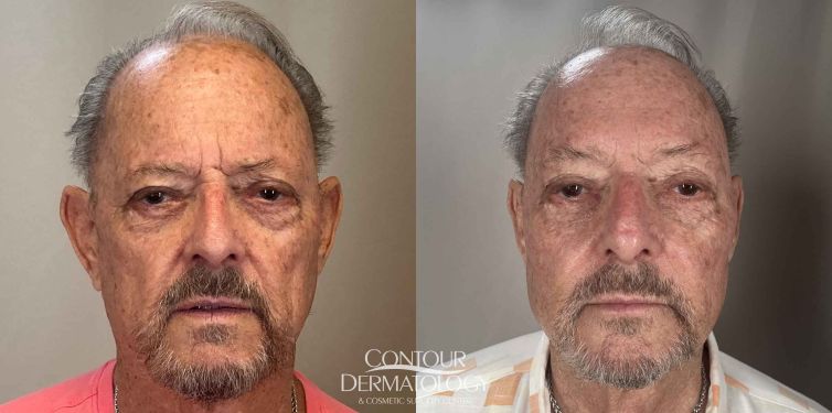 8 ml Voluma in cheeks, 1 ml Juvéderm Vollure to eyebrows, 2 ml Restylane Contour in nasolabial folds, 80-year-old man.