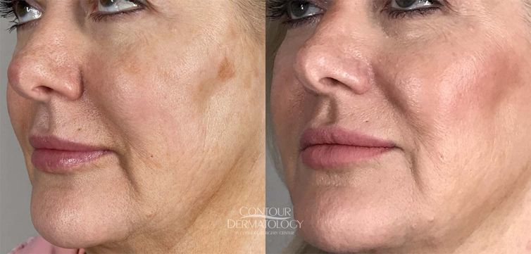 Juvéderm Voluma for cheeks, 63-year-old woman