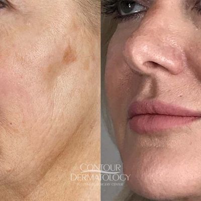 Juvéderm Voluma for cheeks, 63-year-old woman