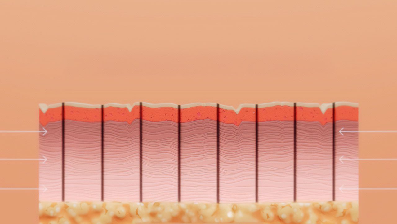 After the skin is removed, the body’s natural healing response quickly closes the cores, resulting in an improved appearance.
