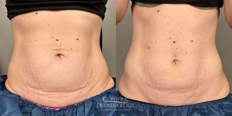 Ellacor for body. stretchmarks treatment