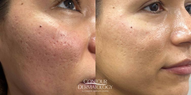 Ellacor treatment for acne scars