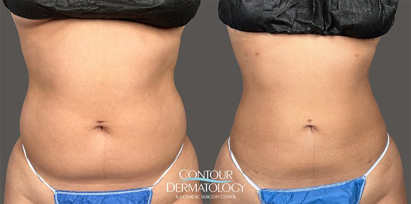 3 months after Liposculpture for Abdominal Fat Reduction