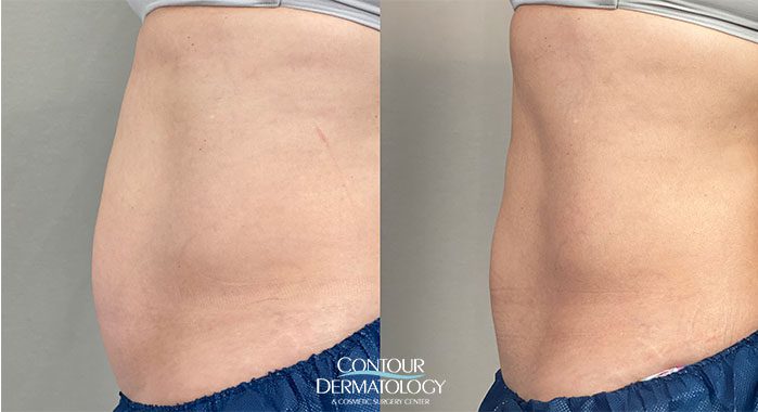 3 months after CoolSculpting to Lower Abdomen