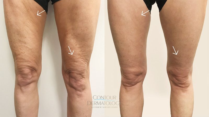 After 5 VelaShape III Treatments for Skin Laxity on Thighs/Knees