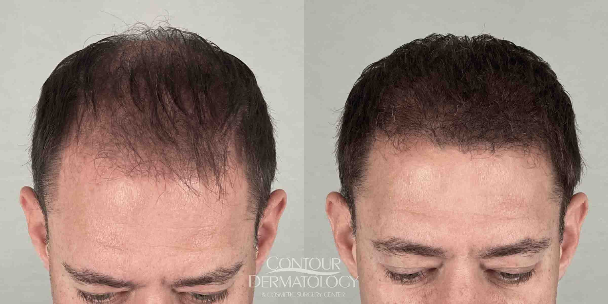 082524 FUE Hair | Contour Dermatology