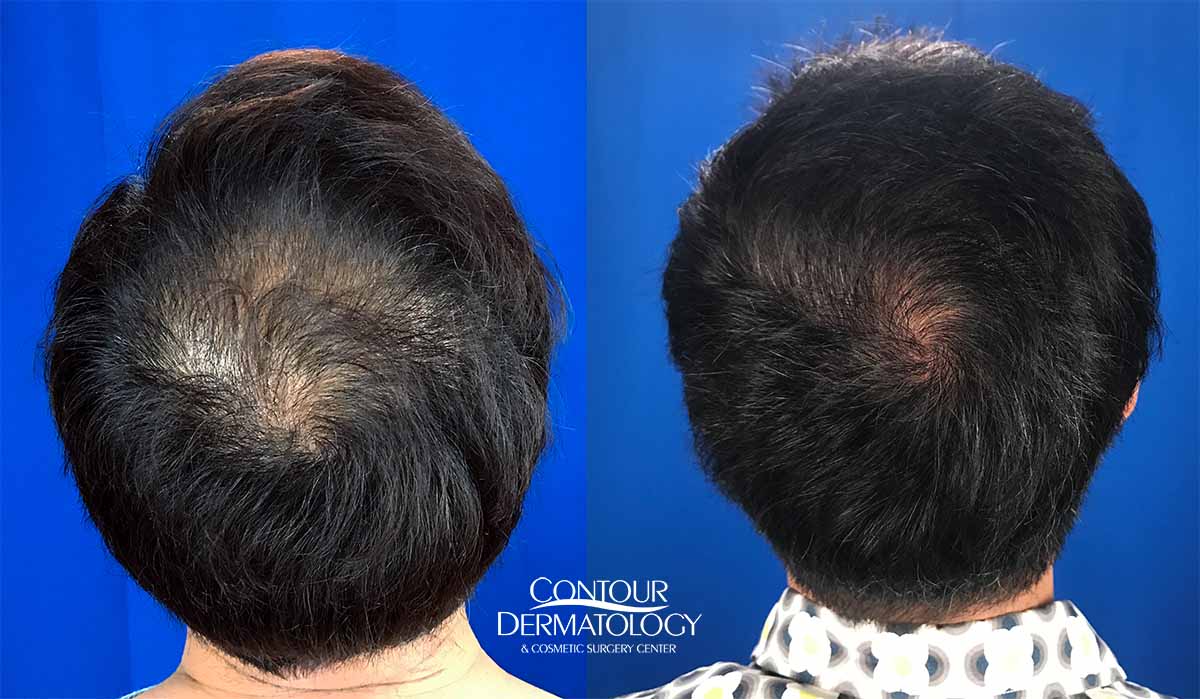 20220927-hair-transplant-strip-graft-lg | Contour Dermatology
