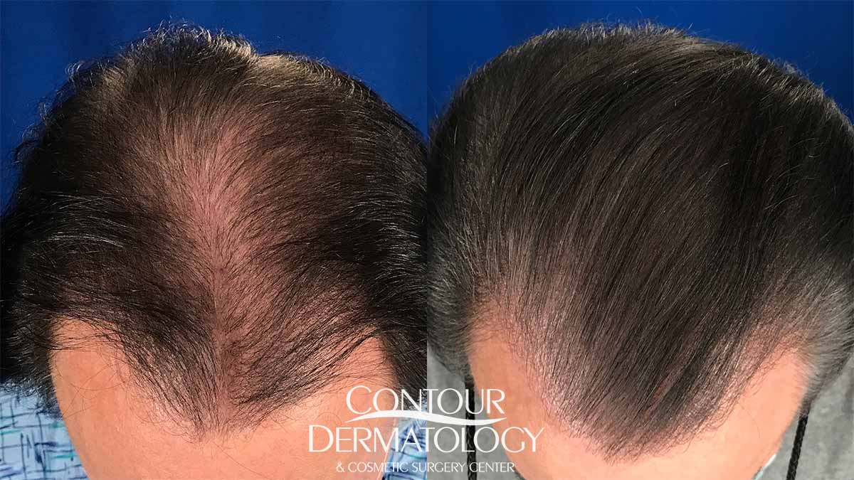 Hair transplant, 7 months after | Contour Dermatology Hair transplant, 7 months after