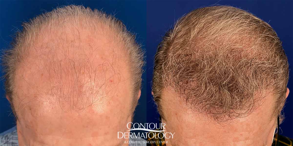 20230203-hair-transplant-lg | Contour Dermatology