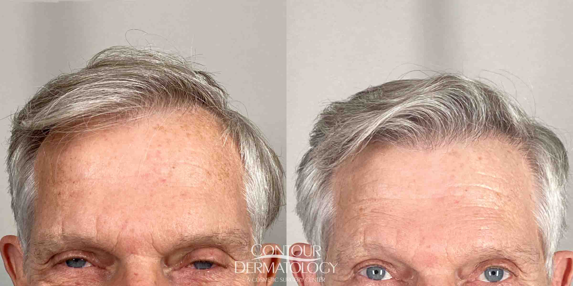 20241204-male-hair-transplant | Contour Dermatology