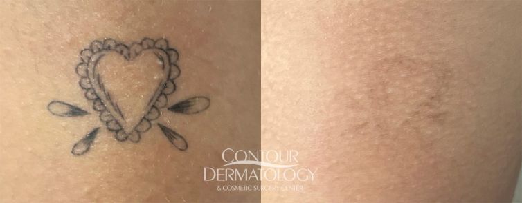 Before and after tattoo removal on a 23-year-old female patient showing significant fading of a small heart tattoo after PicoWay laser treatment.