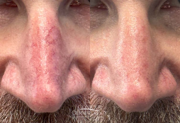 Before and after image showing nasal skin appearance before Excel V laser treatment and after treatment.