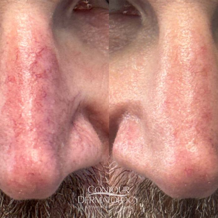Before and after image showing nasal skin appearance before Excel V laser treatment and after treatment.