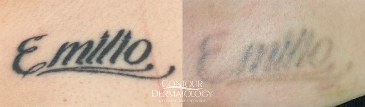Before and after photos of a 30-year-old female patient showing progressive fading of a script tattoo after the eighth laser tattoo removal treatment using PicoWay Resolve.