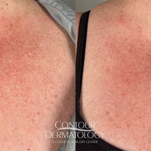 Before and after photos of a 42-year-old female patient showing reduced redness and improved skin tone on the chest following two IPL treatments.