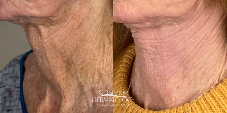 Fractional C02 performed on Neck