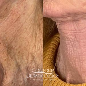 Fractional C02 performed on Neck