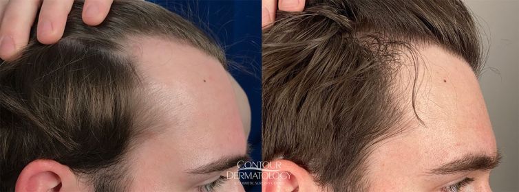 Before and after photos of a 26-year-old male patient showing improved frontal hairline density following FUT hair transplant surgery.