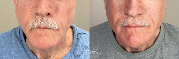 Sculptra, 67-year-old Male