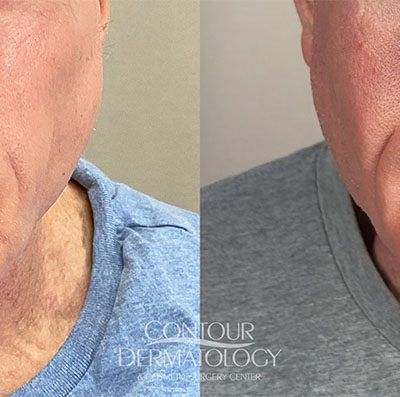 Sculptra, 67-year-old Male