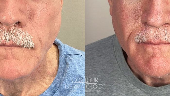 Sculptra, 67-year-old Male