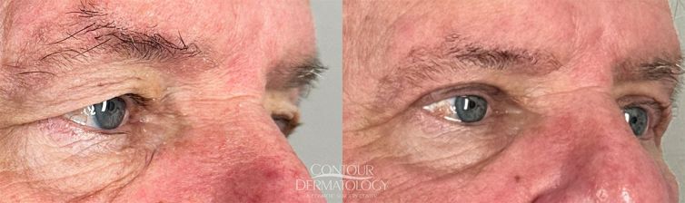 Upper Blepharoplasty Male post 1 month