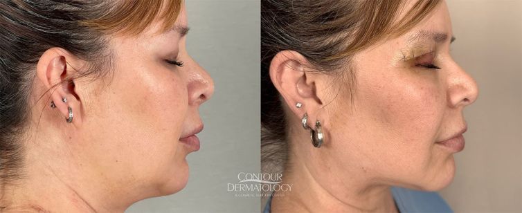 Chin liposculpture before and after