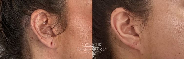 Earlobe repair before and after