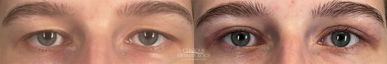 Upper eyelid surgery (upper blepharoplasty) 2 months after