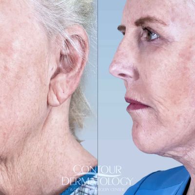 Mini facelift before & after